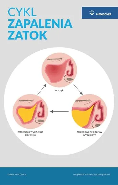 Zapalenie zatok